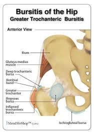 Pin On Pain In The Butt Ischial Bursitis