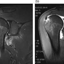 Stream tracks and playlists from hagl on your desktop or mobile device. A Posterior Anterior Glenohumeral Ligament Hagl Lesion Disappearing Download Scientific Diagram