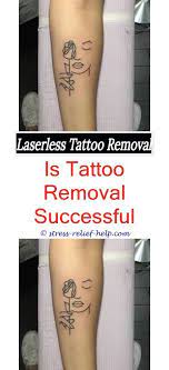 How Much Does It Cost To Get Laser Tattoo Removal Fading Fast Laser Tattoo Removal How To Remove Black Finge Laser Tattoo Homemade Tattoos Tattoo Removal Cream