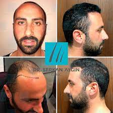 Sac Ekimi Oncesi Ve Sonrasi Sacekimi Sacekimiuzmani Sacekimmerkezi Sacekimioncesi Sacekimisonrasi D Best Hair Transplant Hair Transplant Cool Hairstyles