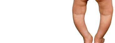 Image result for Rickets