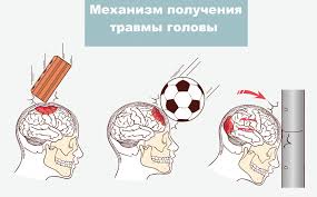 Внутричерепные гематомы
