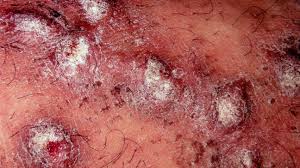 Image result for scabies in the groin area