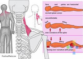 Pin On Neck Pain