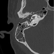 Image result for Bacterial Labyrinthitis