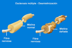 Resultado de imagen de esclerosis