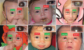Free App Automatically Looks For The White Eye Cancer Symptom In Your Phone S Pictures Daily Mail Online