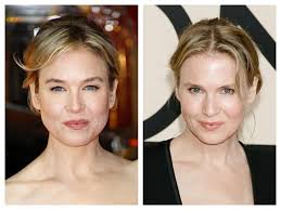 Not that it's anyone's business, but i did not make a decision to alter my face and have surgery on my eyes. Renee Zellweger Plastic Surgery Aventura Plastic Surgery