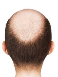 Stress takes a toll on hair too. Ask The Good Enough Guy I M Not Attracted To My Balding Boyfriend Good Enough Mother