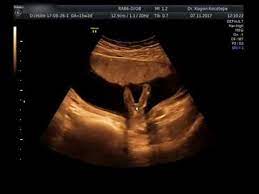 15 haftalik gebelik cinsiyet belli oluyor kiz mi erkek mi youtube