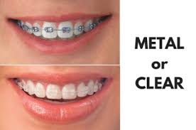 How long do braces take to straighten the teeth? Braces Treatment In Nagpur Transparent Braces In Nagpur