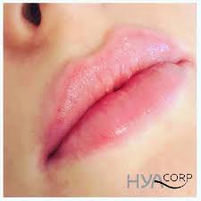 En analyse réelle, les limites inférieures et supérieures sont des outils d'étude des suites de nombres réels. Repulper Les Levres Sans Chirurgie Injection D Acide Hyaluronique Cshp