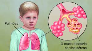 A fibrose quística é uma doença hereditária, o que significa que é necessário que os pais sejam portadores deste problema para que também o filho nasça com ele. Fibrose Cistica Causas Sintomas E Tratamento