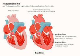Image result for Post-MI Pericarditis