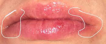 Mundwinkel Lippen Brennen Gesundheit Und Medizin Lippe Brennender Schmerz