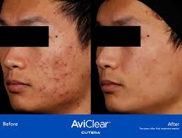 Nashville AviClear Laser ACNE Treatment: "the Biggest Breakthrough in a  Decade!"