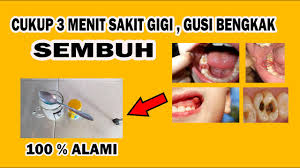 Penting bagi kita untuk mengetahui penyebab gusi bengkak agar kondisi ini bisa diantisipasi, sekaligus cara mengobatinya agar terhindar dari komplikasi. Cukup Dalam 3 Menit Cara Mengobati Gusi Bengkak Dan Sakit Gigi Berlubang 100 Alami Dan Sembuh Youtube