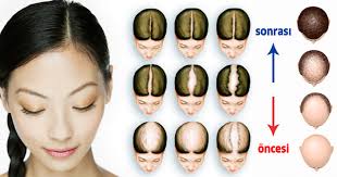 Sac Dokulmesini Onleyen Ve Sac Uzatan Dogal Sarimsak Kuru What Causes Hair Loss Hair Loss Natural Remedy Regrow Hair