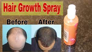 It contains an antioxidant that can make your hair manageable and dandruff free. Hair Growth Spray For Baldness Hair Loss Scalp Infection Tanya Says Youtube
