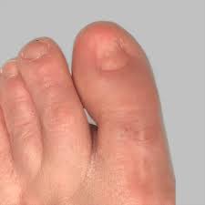 Image result for Toenail Removal