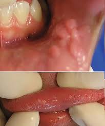 Image result for papillomavirus tongue)