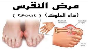 مرض النقرس ماهو النقرس واعراضه قصة شوق