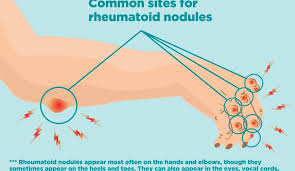 Maybe you would like to learn more about one of these? What Are Rheumatoid Nodules