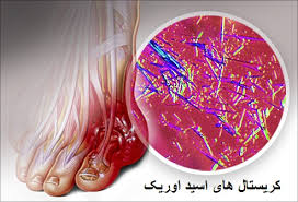 نتیجه تصویری برای درمان نقرس
