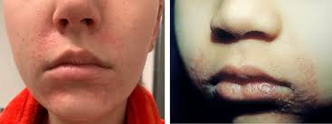 However, in some instances, it may be an indication of an underlying problem. Pink Bumps Around The Mouth It May Not Be Acne Skincare Physicians