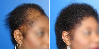 Genetic types of hair loss include alopecia areata and. Hair Loss In African American Women Traction Alopecia Aesthetics Hair Restoration