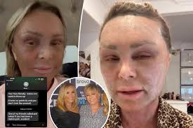 What did Tamra's mother say about plastic surgery?