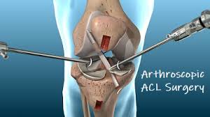 Arthroscopic Acl Surgery Knee Pain Explained