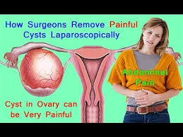 Pin On Pcos