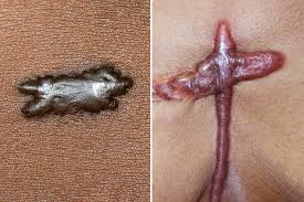 Image result for Keloid