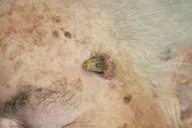 Image result for cornu cutaneum)