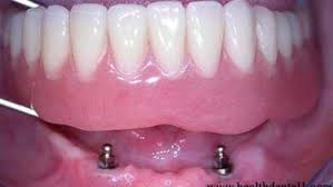 ماهي تركيبات الاسنان المتحركة - صحة اسناني