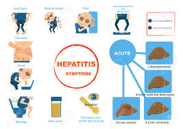 Hospital management of children with acute gastroenteritis. Hepatitis Symptoms Liver Disease Gastroenteritis Info Graphics Royalty Free Cliparts Vectors And Stock Illustration Image 92027910