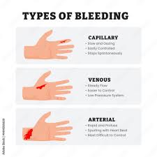 Image result for Hemorrhage Classification