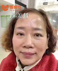 曼悅伶巨美特獨家真皮斑技術一次手工技術一個套餐一步到位，祛斑又逆齡終身受益WeChat : IsabelWong3