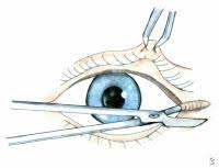 Image result for Lateral Canthotomy