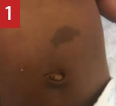 These harmless spots are common in many people. An Infant With Cafe Au Lait Macules Vitiligo And A Hemangioma A Case Of Neurofibromatosis 1 Pediatrics