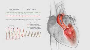 All varieties of silicone catheters, intermittent catheters, bardex infection control, foley catheters intermittent catheters drains urine remaining in the bladder after voiding. Langston Dual Lumen Catheters Us Teleflex