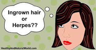 Husain notes pubic hair tends to be thick and curly, and the skin in that area is also pretty thin and delicate, making hair. Ingrown Hair Vs Herpes Find The Differences Including Treatments