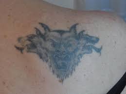 However, a lot of medical options (laser, cryosurgery, dermabrasion, or intensely pulse light therapy) and home remedies are available for tattoo removal. Tattoo Removal Pure Beautiful