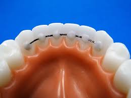 Specialty Appliances Orthodontic Laboratory Categories