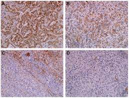 We did not find results for: Cd9 Expression As A Favorable Prognostic Marker For Patients With Malignant Mesothelioma