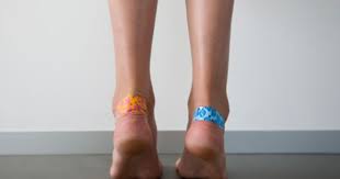 How To Treat A Foot Blister How To Heal Blisters How To Treat Blisters Blister Treatment