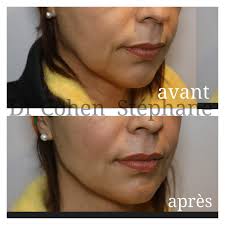 Injection acide Hyaluronique à Créteil