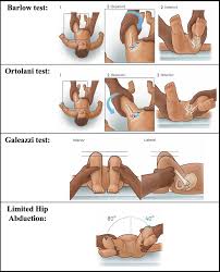 Image result for Galeazzi Sign