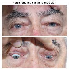 Image result for Entropion
